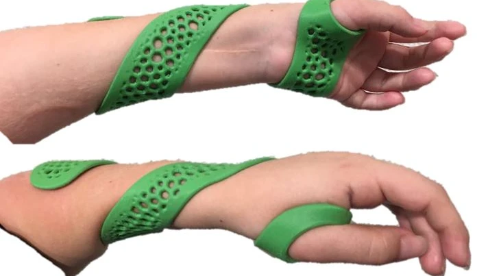 3D Druck Handorthese.JPG
