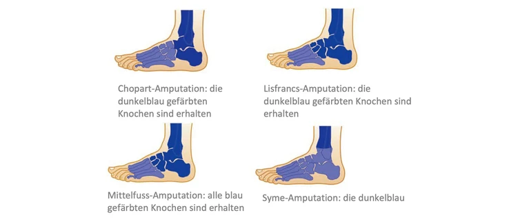 Bild_Loesungen_Prothetik_Fussprothesen_Abbildung