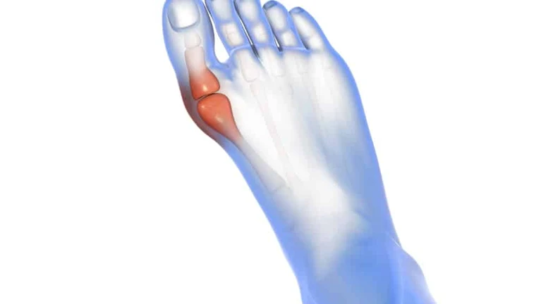 Hallux valgus.jpg